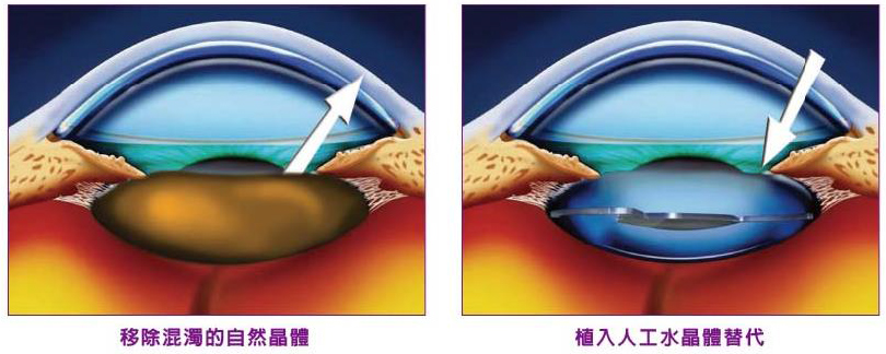 白內障手術
